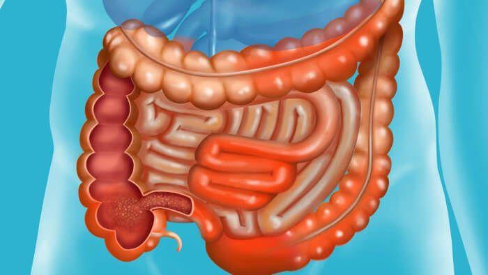 bedeninizde 10 kiloya kadar dışkı birikebileceğini biliyor muydunuz