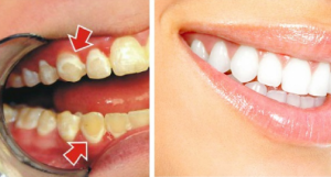 Sadece 5 Dakikada Dişlerinizdeki Plakları Nasıl Çıkarabilirsiniz?